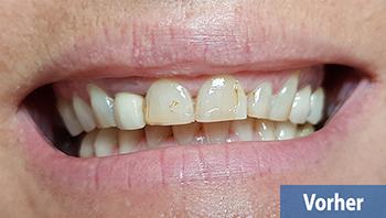 Zahnbehandlung mit 28 Stück E-Max Prime Zahnkronen