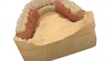 Zahnbehandlung mit bio kombiniertem Zahnersatz aus Zirkon und Peek