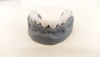 Ästhetische Zahnmedizin – E-Max Prime Kronen