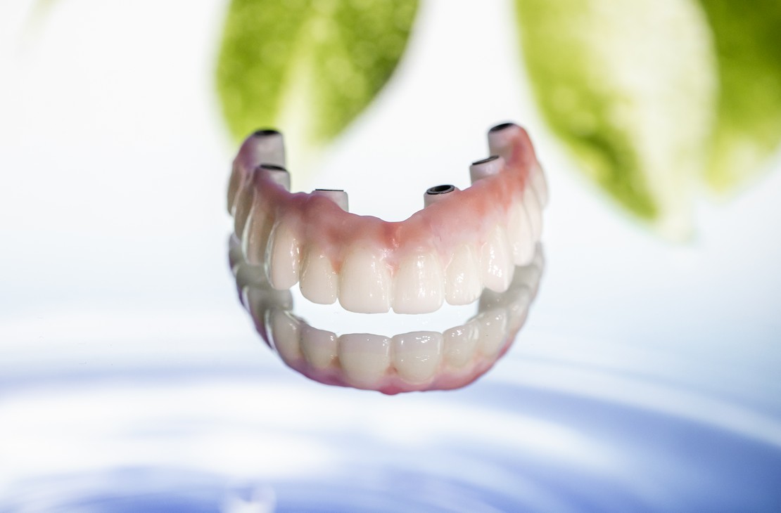 Zahnimplantatversorgung - die beste Alternative für Sie