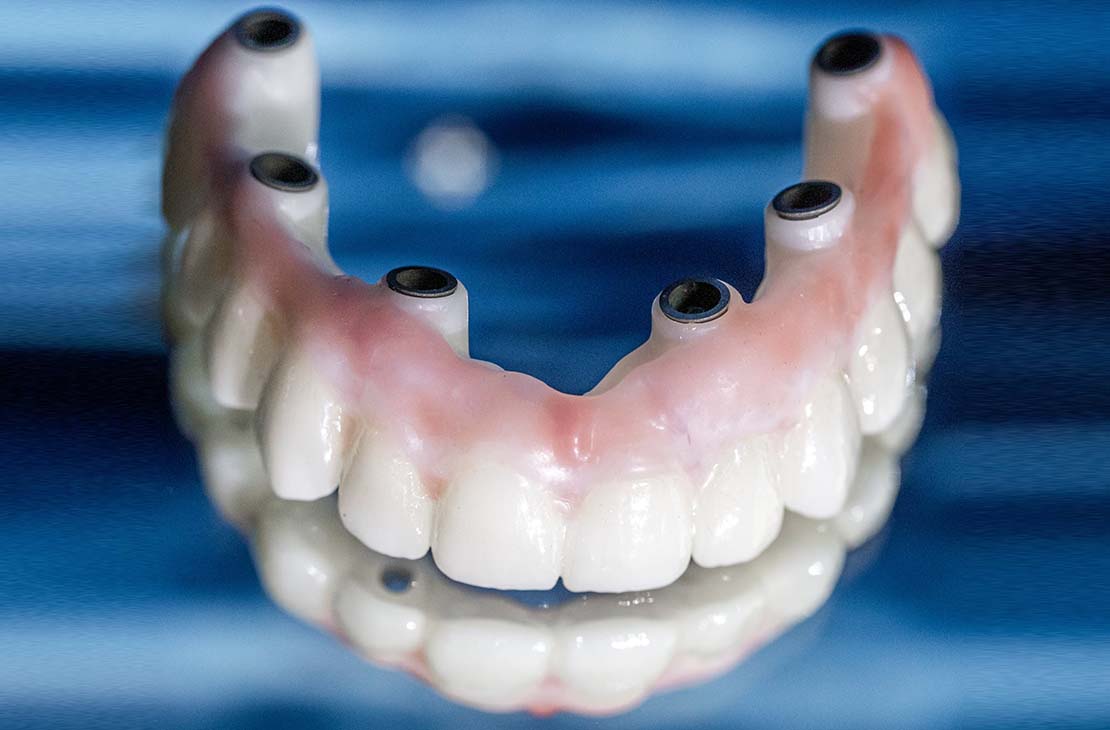 Geklebter Implantat getragener fixer Zahnersatz