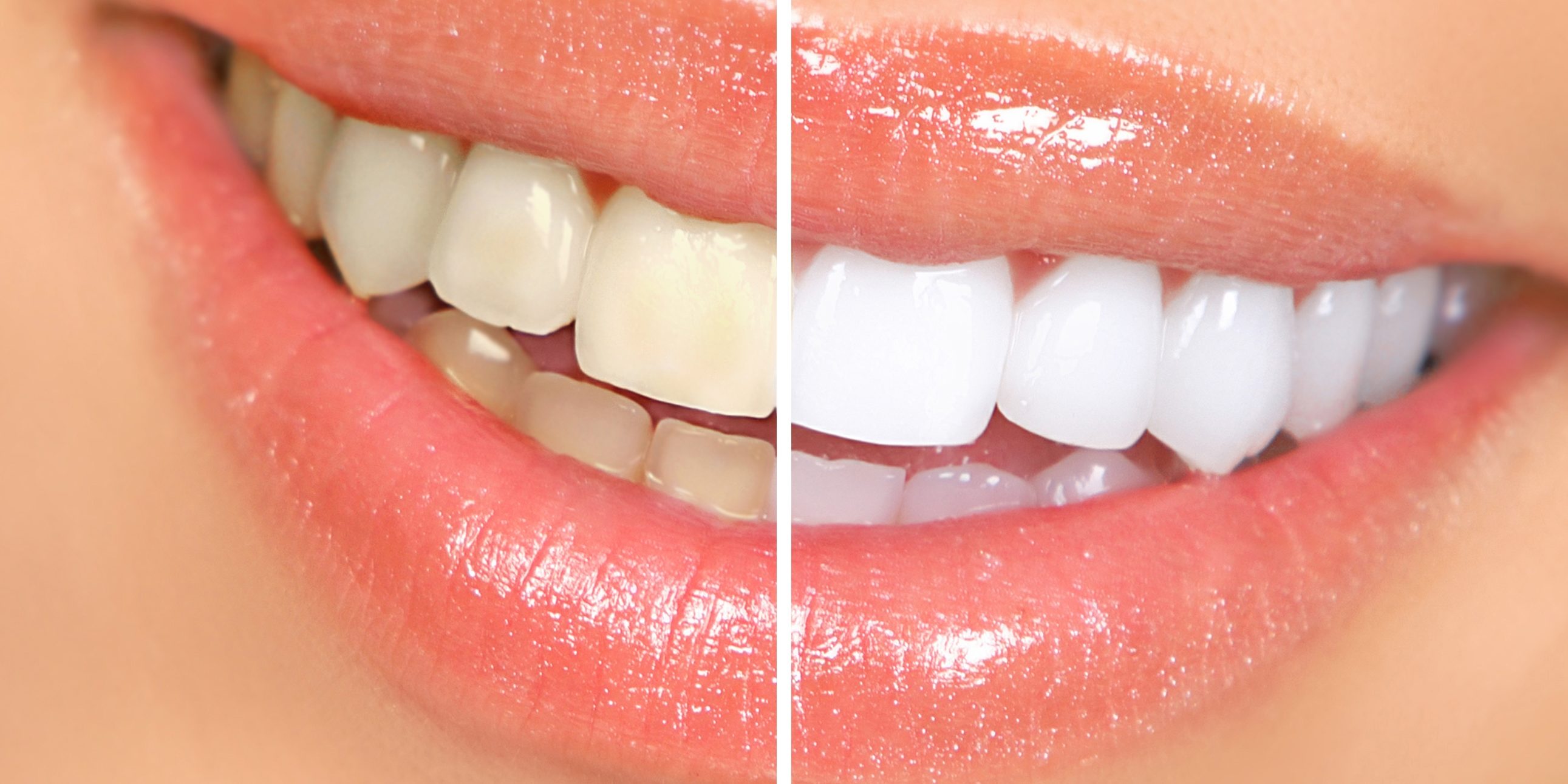 Unterschiede zwischen der häuslichen und zahnärztlichen Zahnaufhellung