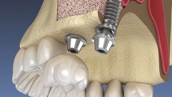 Sinuslift - Anheben der Kieferhöhle in der Zahnmedizin