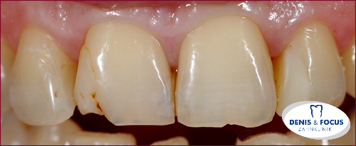 Fall: Zahnbleaching und Veneers