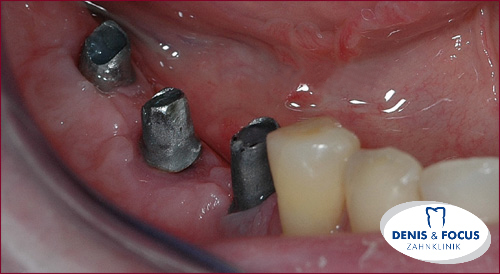Fall: Einseitige Zahnlücke durch Implantate ersetzen