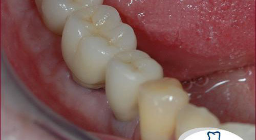 Fall: Einseitige Zahnlücke durch Implantate ersetzen