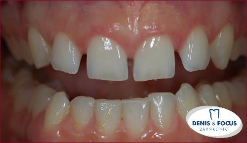 Fall: Diasthema zwischen den Zähnen durch Veneers korriegiert