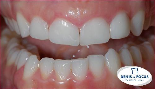 Fall: Diasthema zwischen den Zähnen durch Veneers korriegiert