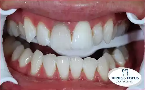 Grau zahn wird Zahngranulome