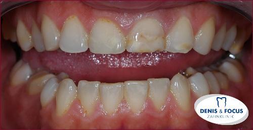 Fall: Zahnschmelzentwicklungsprobleme durch Veneer korrigiert
