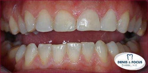 Fall: Zahnschmelzentwicklungsprobleme durch Veneer korrigiert
