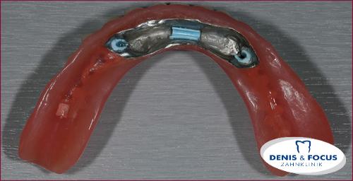 Fall: Untere Prothese auf Implantate mit Steg befestigen