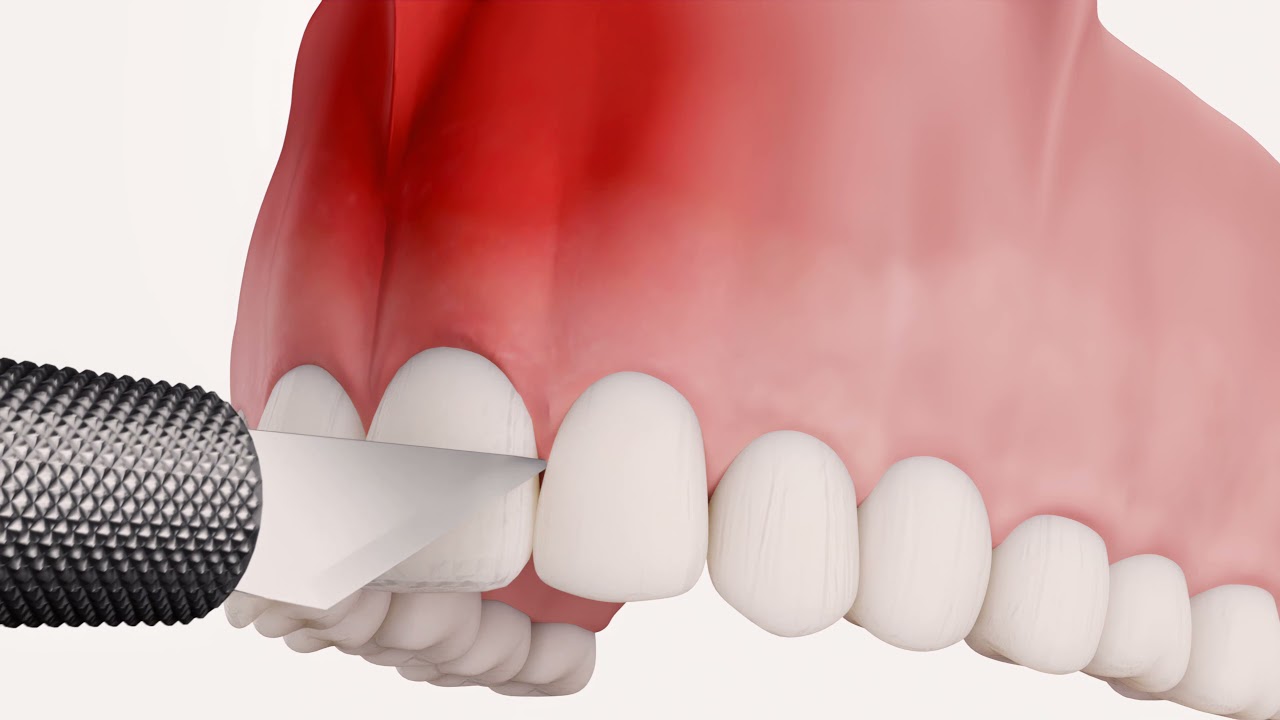 Resection - Denis & Focus Dental Centrum - Ihre Zahnklinik in Ungarn