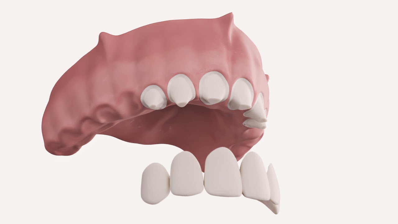 Bio-HPP kombinált fogpótlás - Denis & Focus Dental Centrum - Magyarországi fogászati klinikája