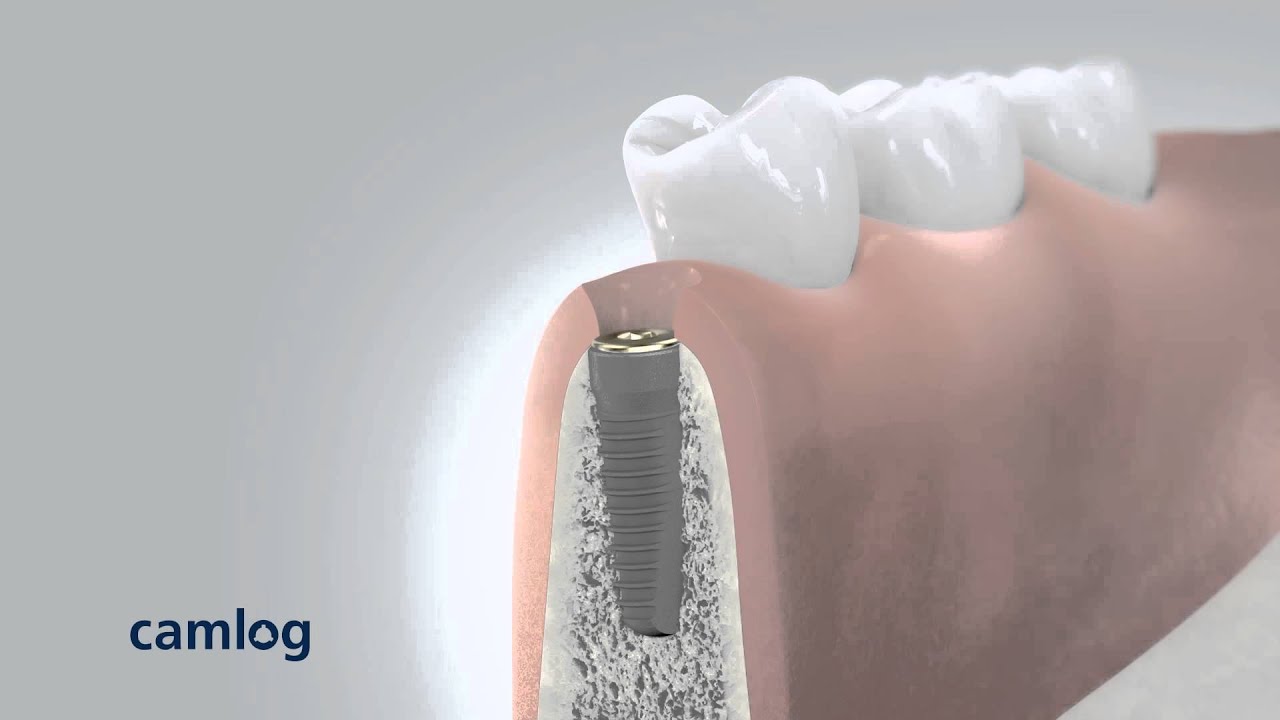 Camlog – Patienteninformation