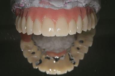 Teleskopprothese – komfortable, ästhetische Lösung