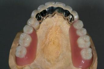 Unterkiefer Teleskopprothese