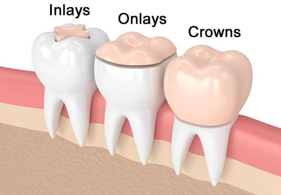 Inlay Onlay Beispiel