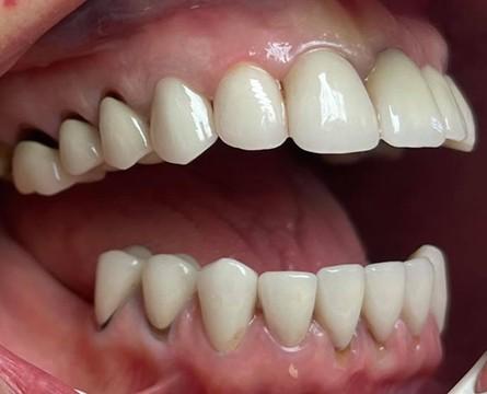 Before: Metal ceramic crown