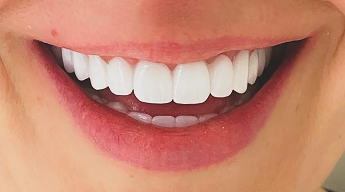 Naturally-colored zircon smile