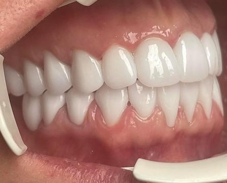Later: Zirconia dental crown