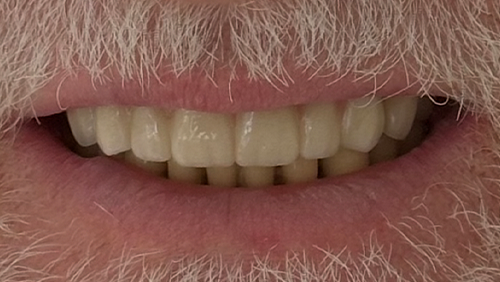 Vorher – Fall: 6 St. E-MAX Veneer (Keramikschale)